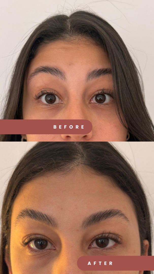 Botox antes e depois
