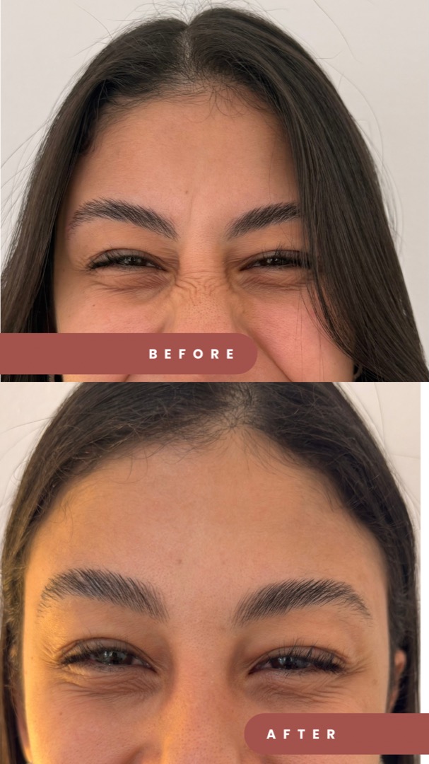 Botox antes e depois