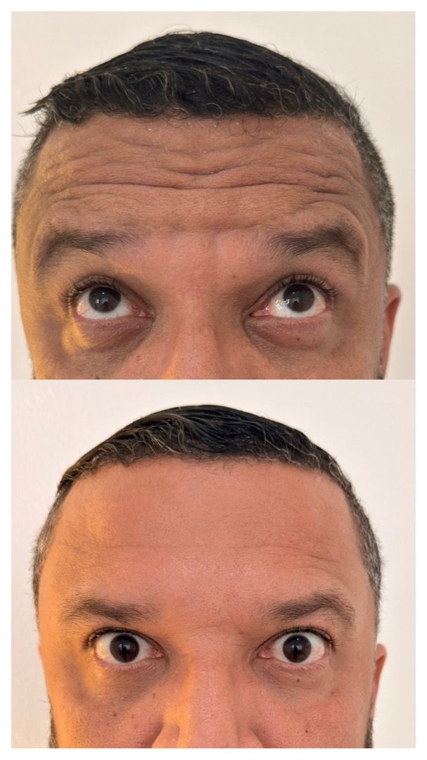 Botox antes e depois