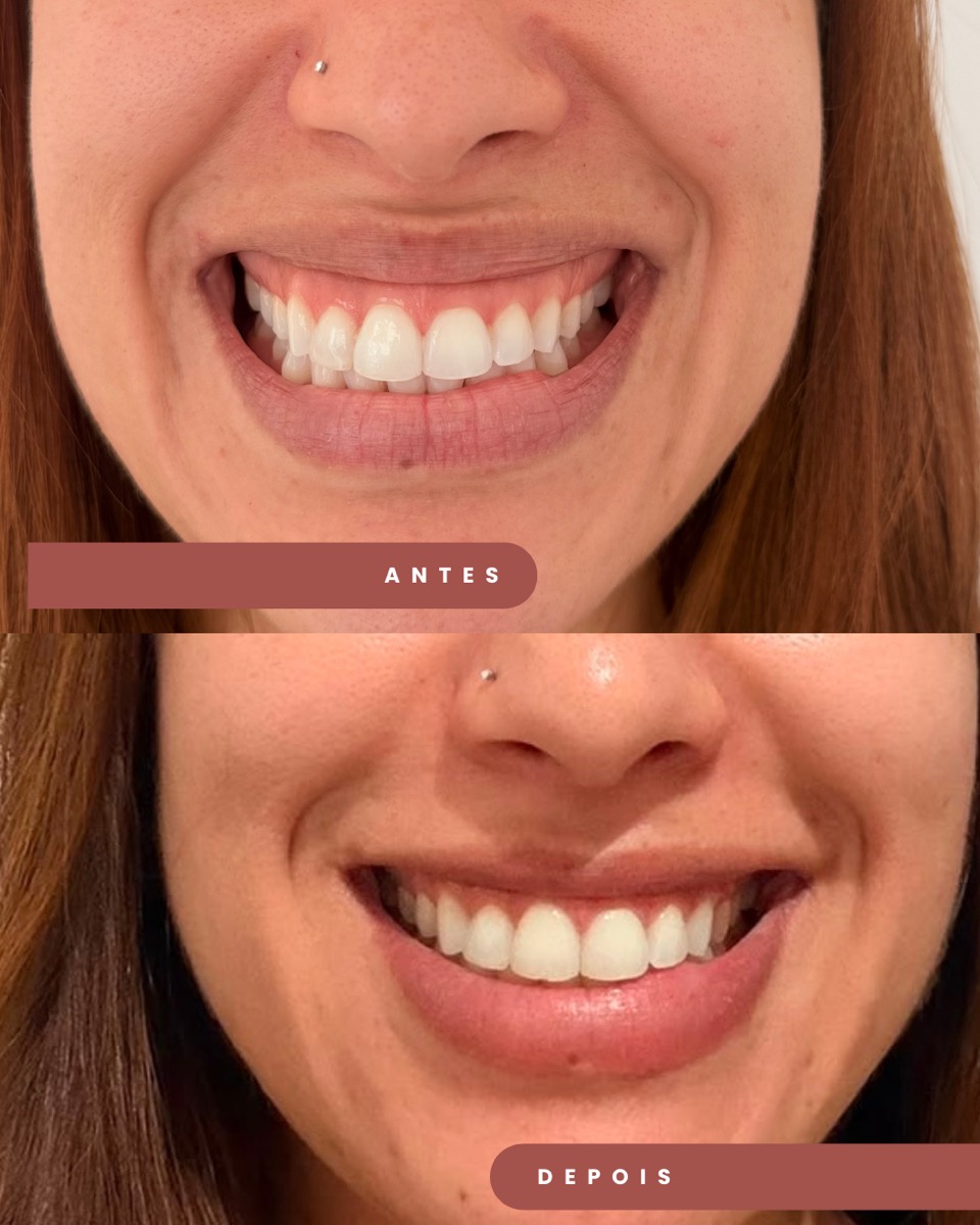 Botox antes e depois