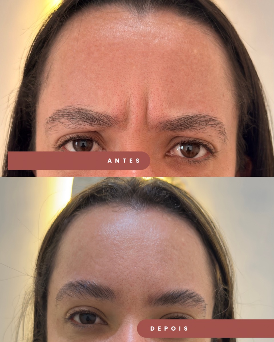Botox antes e depois