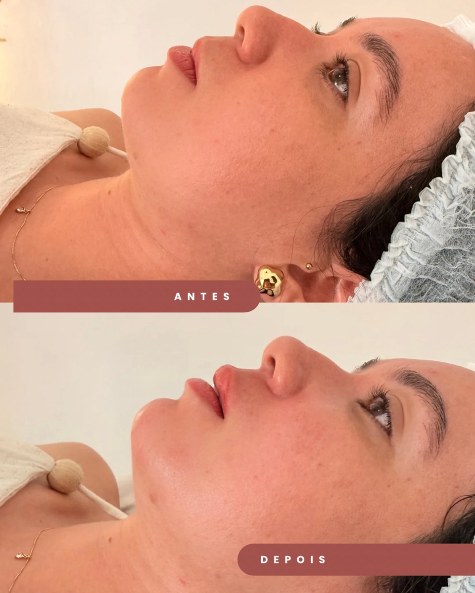 Preenchimento antes e depois